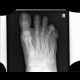 Anomally of the little finger of the foot, congenital: X-ray - Plain radiograph
